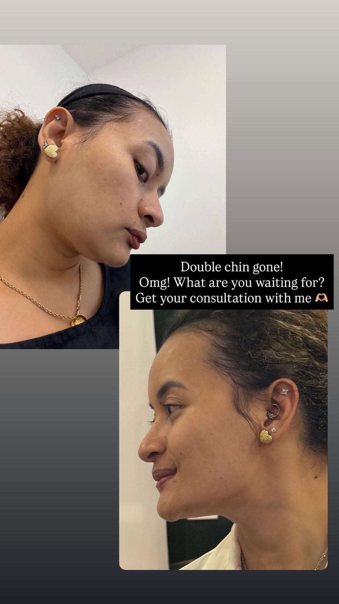 Mesolipo double-chin contouring result